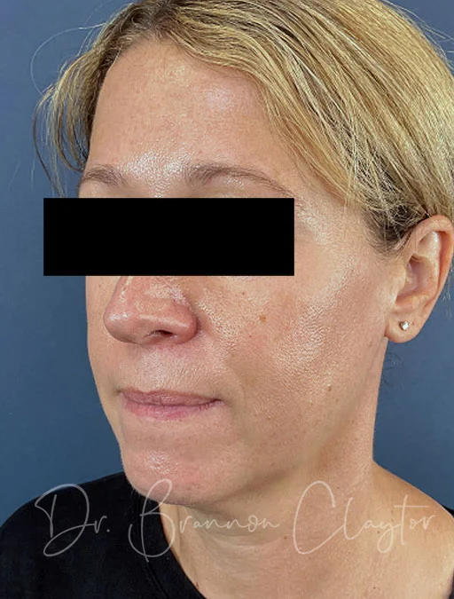 MyEllevate Neck Lift