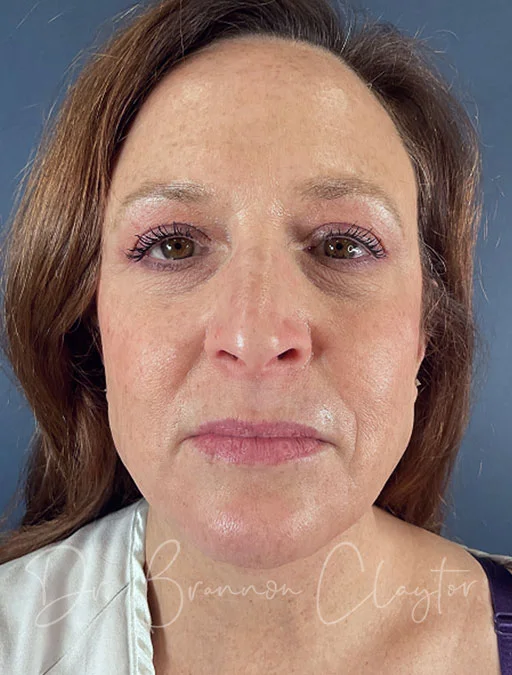 necklift-elevate-lower-blepharoplasty-50288a-after