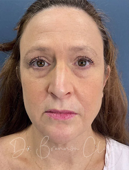 necklift-elevate-lower-blepharoplasty-50288a-before