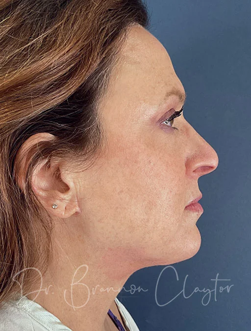 MyEllevate Neck Lift