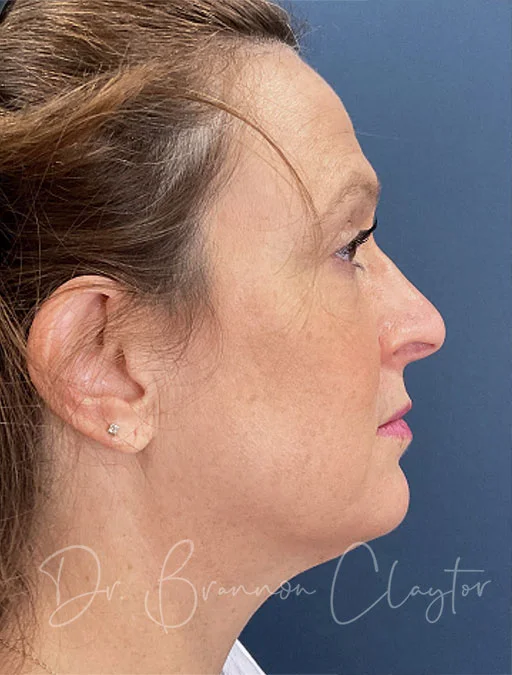 MyEllevate Neck Lift