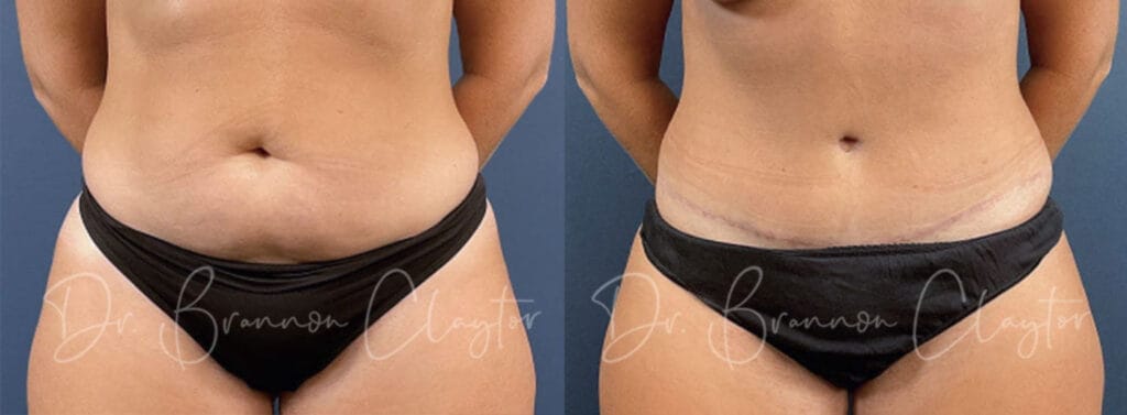 Before and after drainless tummy tuck with Philadelphia tummy tuck surgeon Dr. R. Brannon Claytor