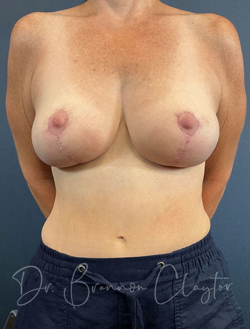 Breast Lift