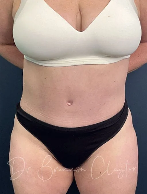 Unsightly scars after abdominoplasty - Hourglass Tummy Tuck
