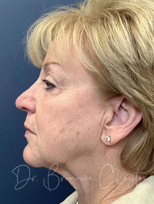 face-RHA-filler-33004c-before