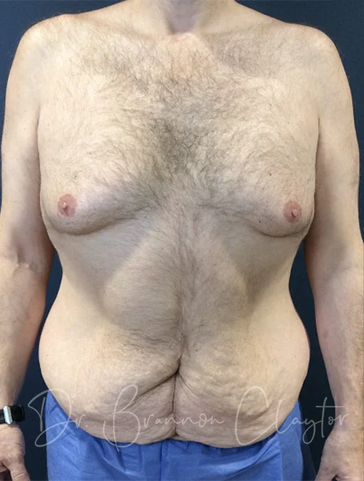 The same patient as in Figure 1 following belt lipectomy. The