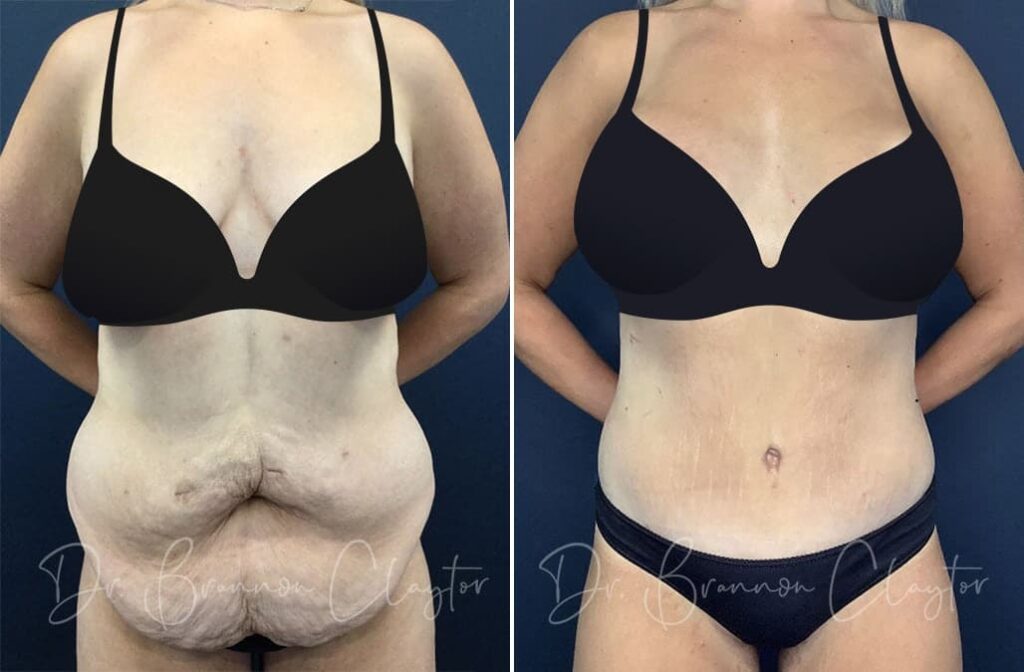 Before and after post weight loss body lift surgery with Dr. Claytor in Philadelphia