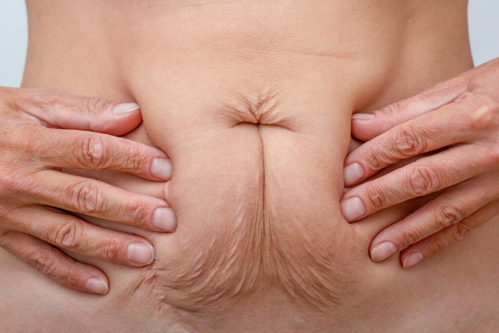 Close up of woman with hands on stomach with sagging skin after weight loss