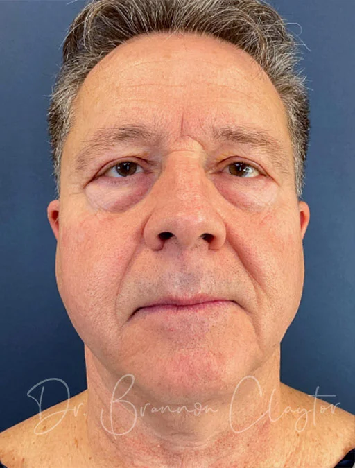 eyelid-lift-upper-lower-male-51682a-before