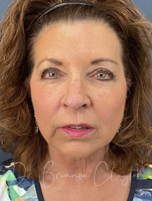 facelift-neck-lift-51466a-after