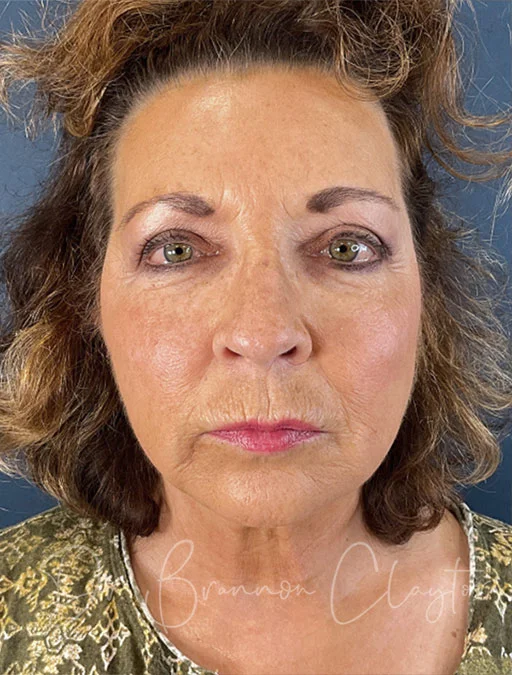 facelift-neck-lift-51466a-before