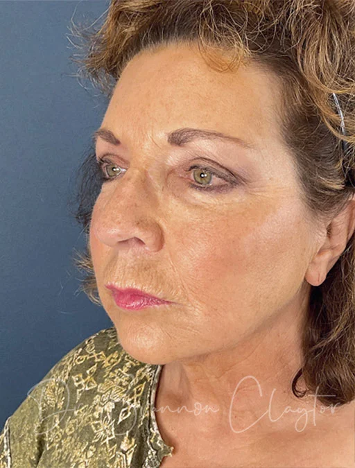 facelift-neck-lift-51466b-before