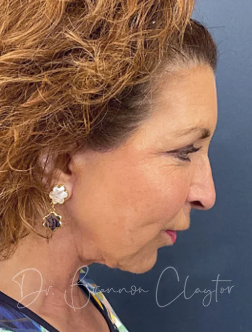 facelift-neck-lift-51466d-after