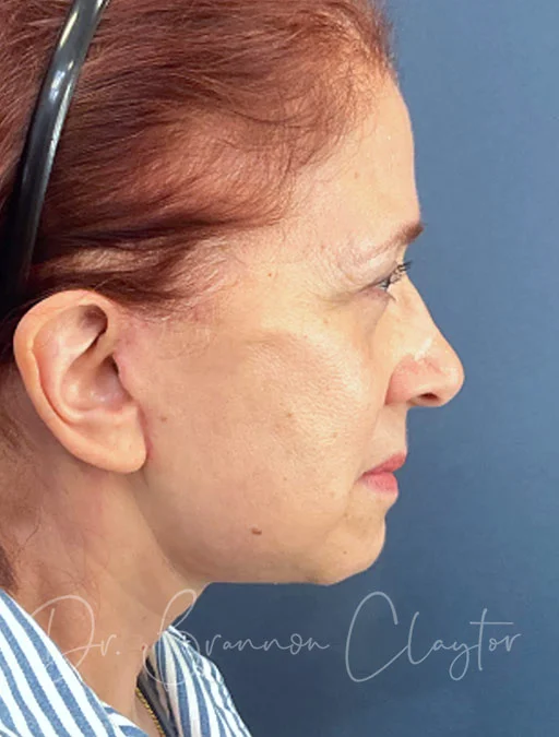 Deep Plane Facelift and Browlift