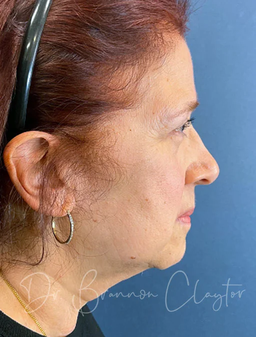 Deep Plane Facelift and Browlift