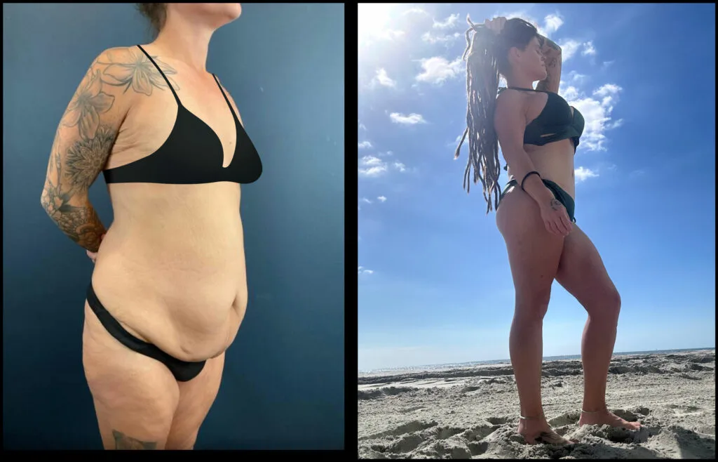 before and after drainless tummy tuck with dr brannon claytor