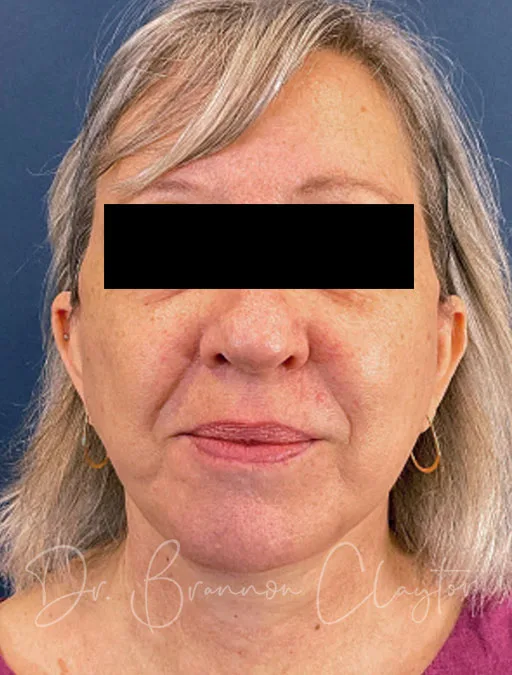 facelift-lower-neck-lift-52397a-after