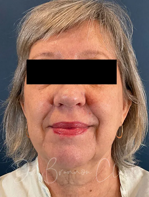 facelift-lower-neck-lift-52397a-before