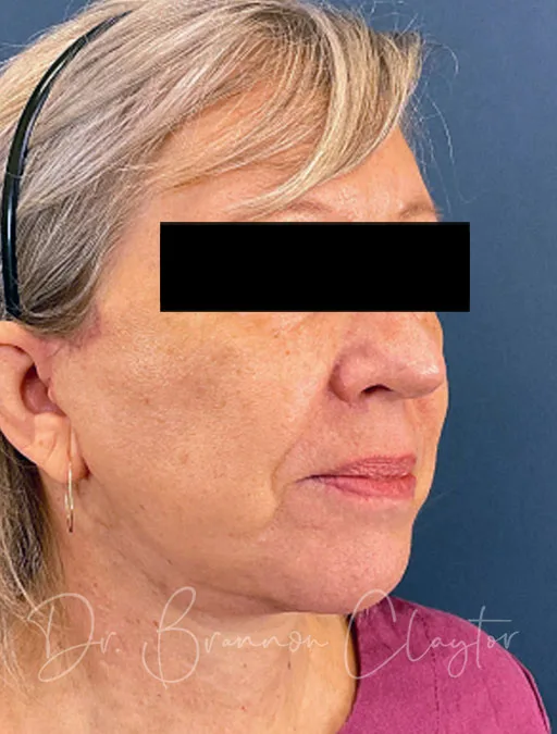 facelift-lower-neck-lift-52397b-after