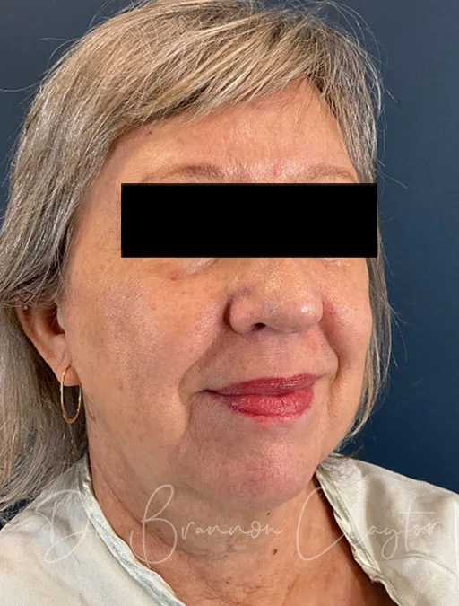 facelift-lower-neck-lift-52397b-before