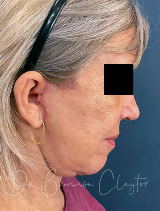 facelift-lower-neck-lift-52397d-after