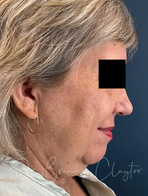 facelift-lower-neck-lift-52397d-before