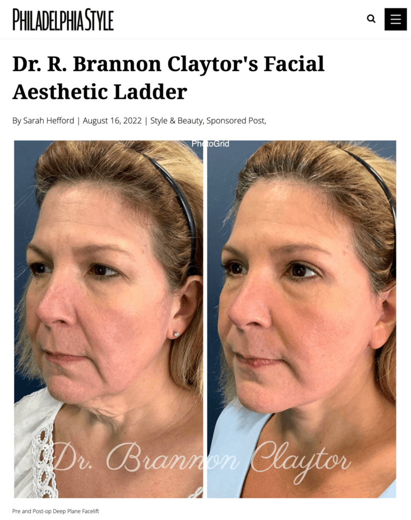 Screenshot of article in Philadelphia Style, P"hiladelphia plastic surgeon Dr. R. Brannon Claytor's Facial Aesthetic Ladder" showing deep plane facelift patient before and after results