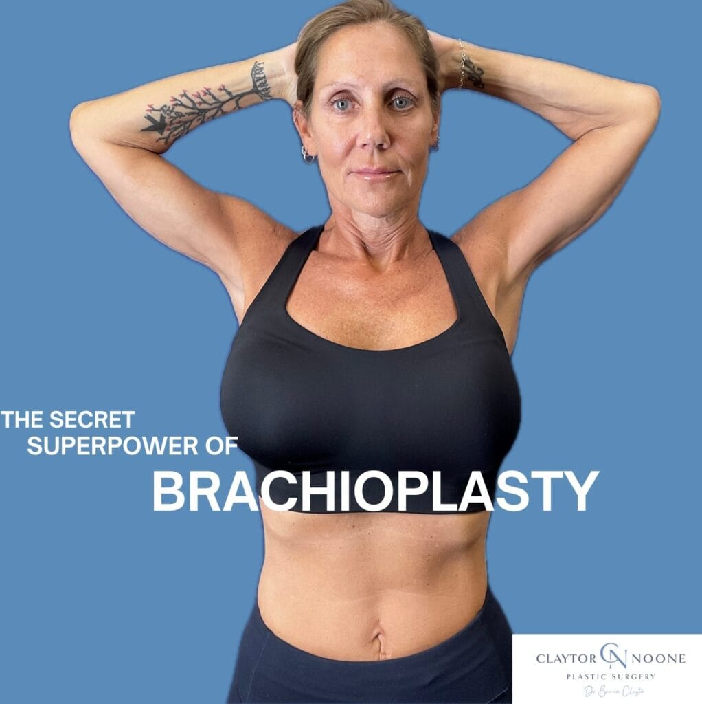 The superpower of brachioplasty (arm lift) with Dr. Claytor