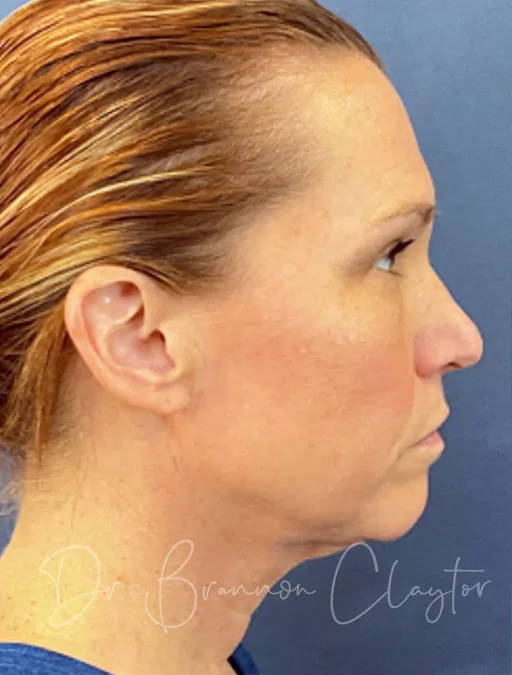 MyEllevate Necklift