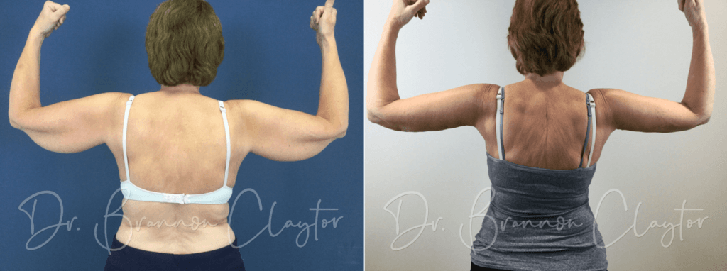 58-year-old patient shown before and after a drainless arm lift with Philadelphia arm lift surgeon Dr. Claytor