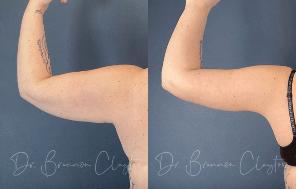 Female patient shown before and after a drainless arm lift with Dr. Claytor in Philadelphia