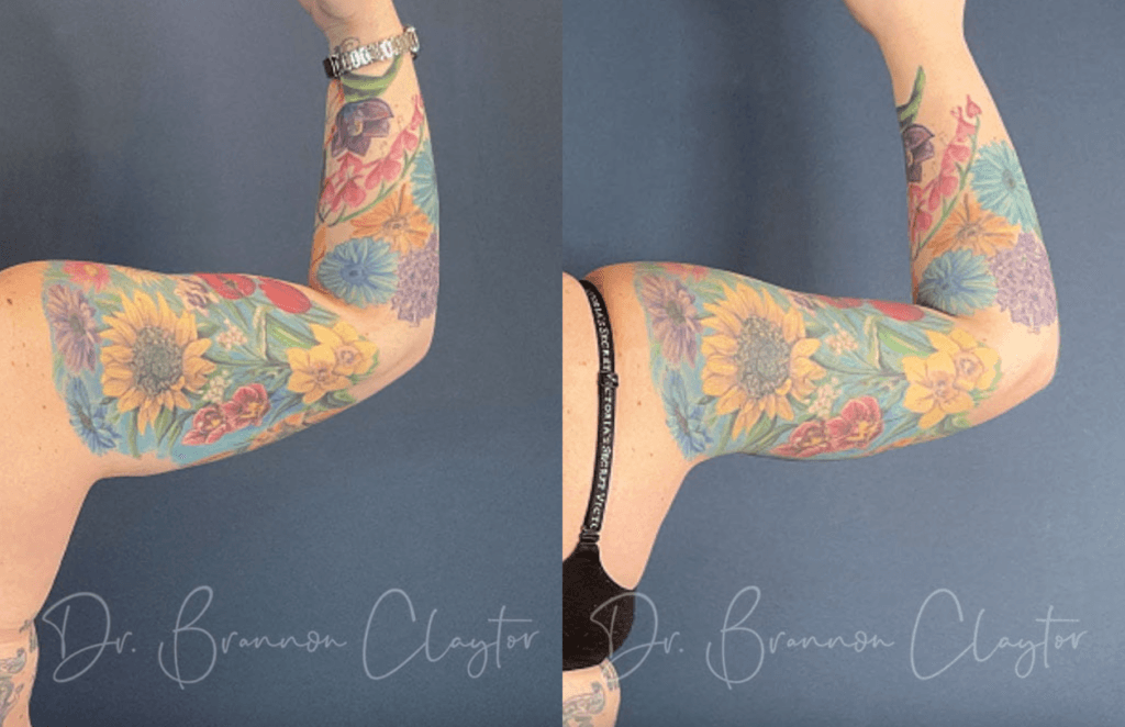 Female patient shown before and after a drainless arm lift in Philadelphia with Dr. Claytor