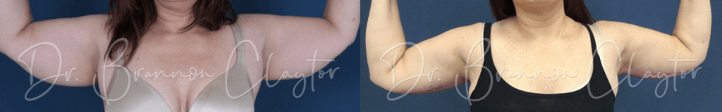 Patient shown before and after a drainless arm lift in Philadelphia with Dr. Claytor