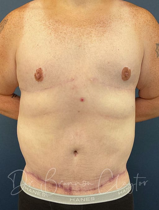 Belt Lipectomy & Gynecomastia