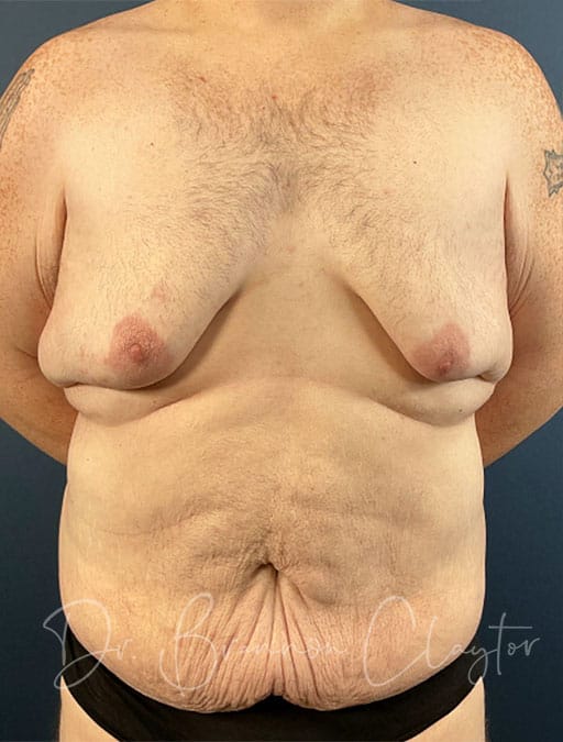 Belt Lipectomy & Gynecomastia