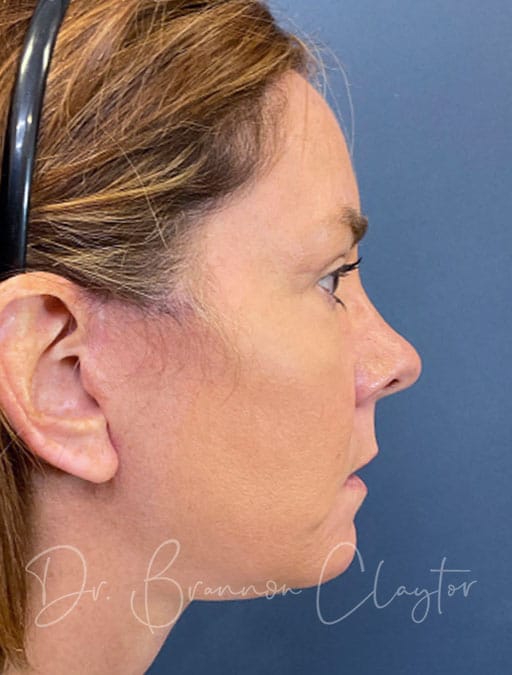 Deep Plane Facelift, Neck Lift & Upper Eyes