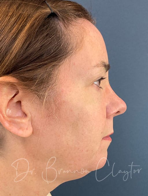 Deep Plane Facelift, Neck Lift & Upper Eyes