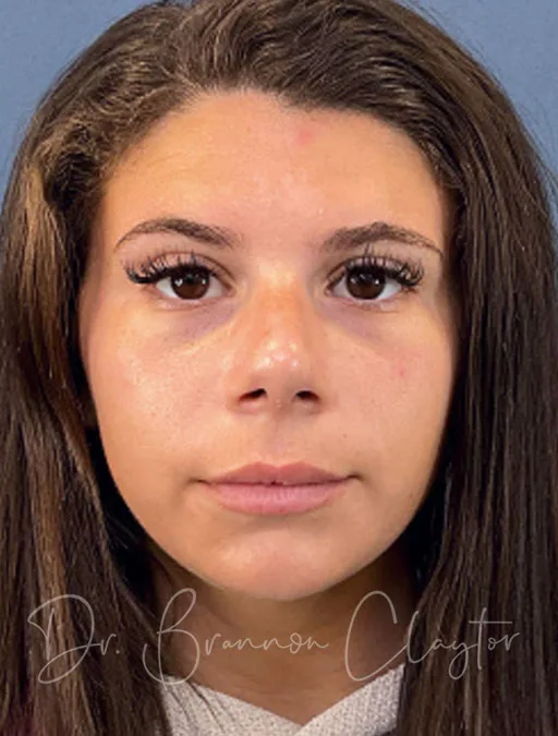 rhinoplasty-septoplasty-50985a-after-claytor