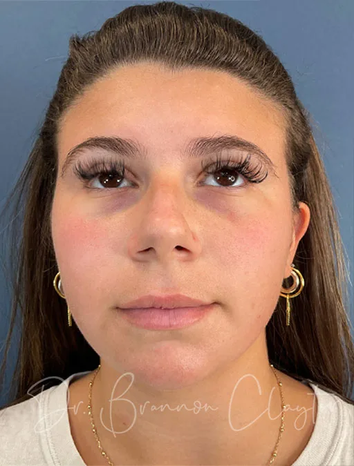 rhinoplasty-septoplasty-50985a-before-claytor