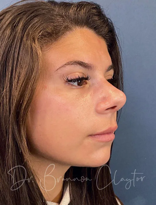 rhinoplasty-septoplasty-50985b-after-claytor