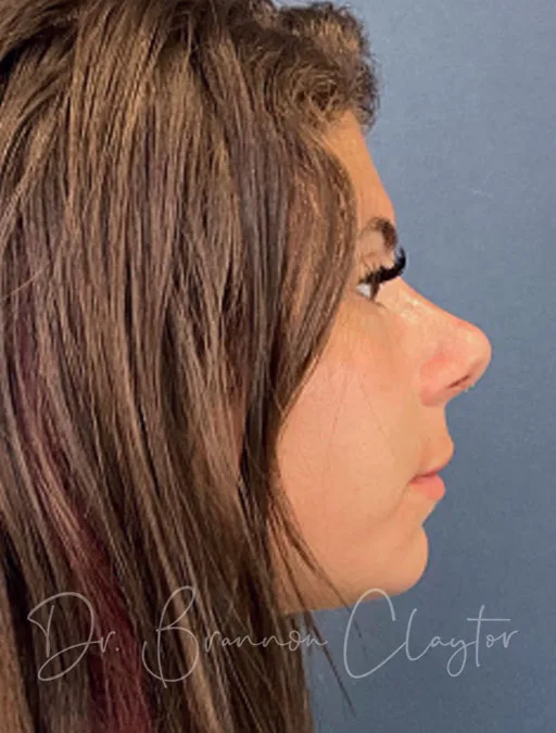 Rhinoplasty & Septoplasty