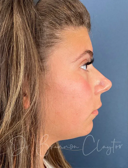 Rhinoplasty & Septoplasty