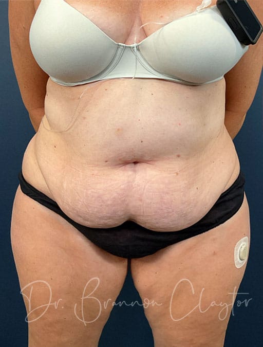 Drainless Tummy Tuck