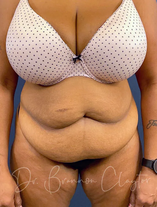 tummy-tuck-fat-injections-52417a-before-claytor