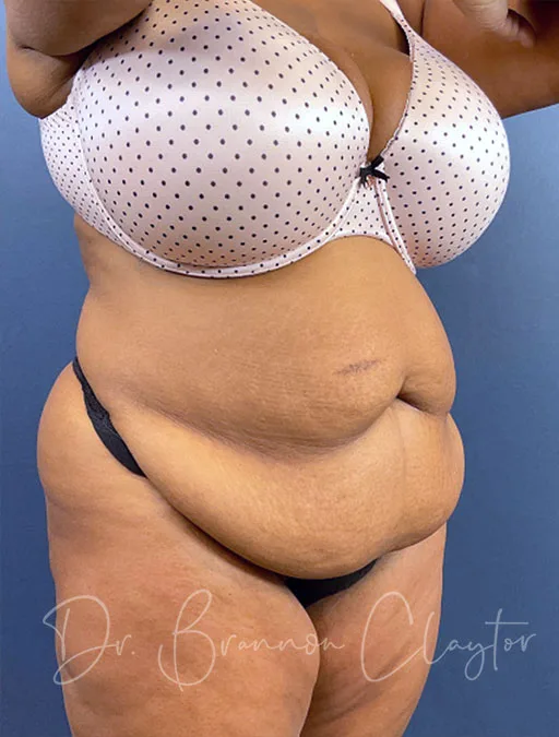 tummy-tuck-fat-injections-52417b-before-claytor