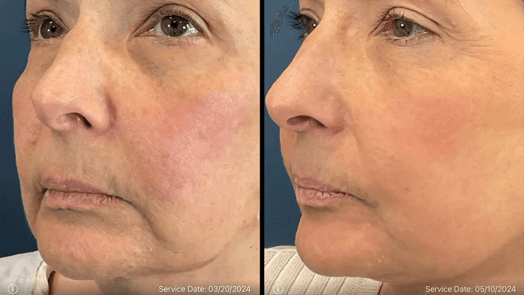 Before and after LaMiNa facial rejuvenation with Dr. Claytor in Philadelphia