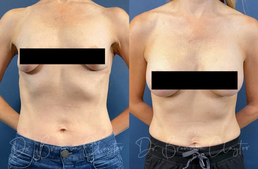 Before and after mini breast augmentation with small breast implants with Dr. Claytor in Philadelphia