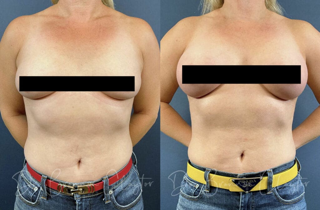 Before and after mini breast augmentation with small breast implants with Dr. Claytor in Philadelphia