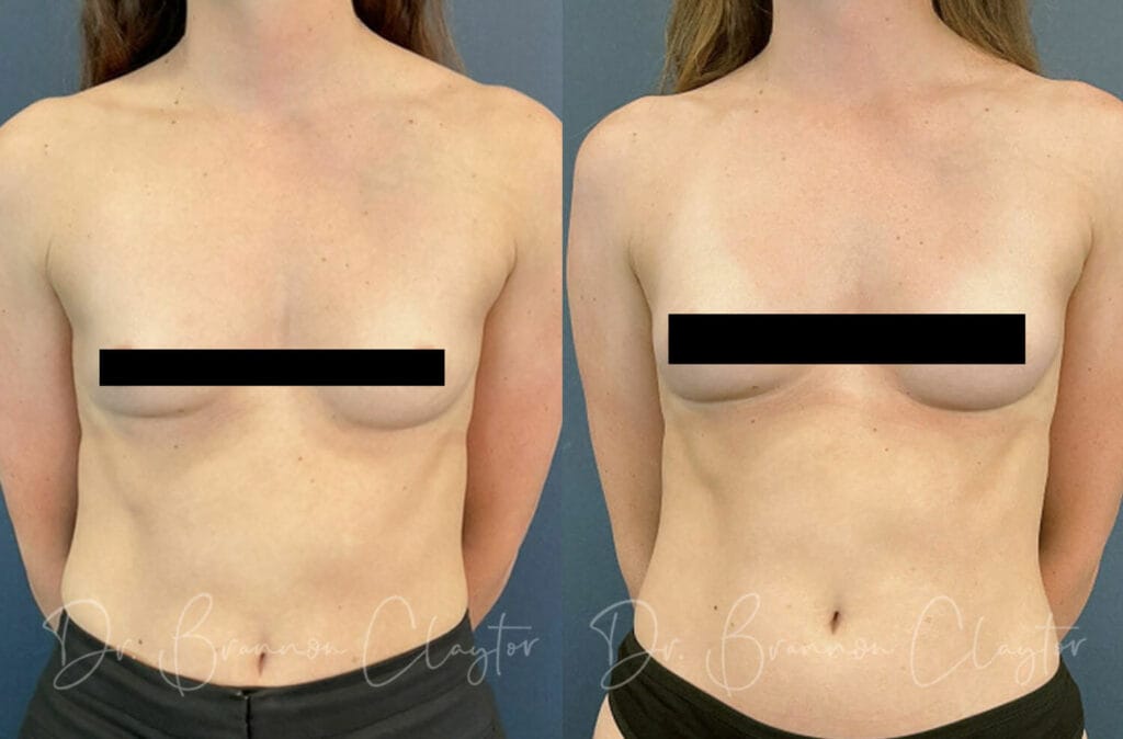 Before and after mini breast augmentation with small breast implants with Dr. Claytor in Philadelphia